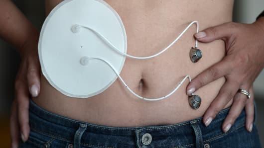 A woman wears an early prototype of a bio-artificial pancreas (BAP) at the European Center for the Study of Diabetes on July 3, 2014, in Strasbourg, eastern France.