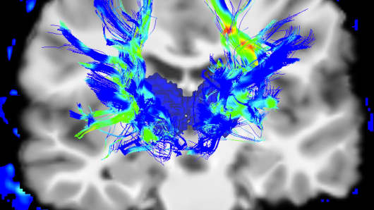 Coronal view of a human brain in Parkinson's disease
