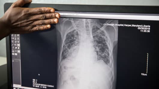 A lung x-ray that clearly shows tuberculosis, in Liberia. Liberia is listed as one of the high-burden countries for tuberculosis by the World Health Organization.
